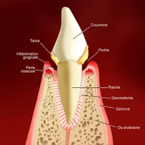 Parodontie-parodontiste-gingivite-docteur-sy