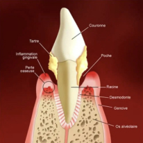 Parodontie-parodontiste-gingivite-docteur-sy