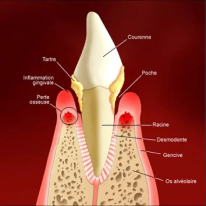 Parodontie-paris-9-parodontiste-gingivite